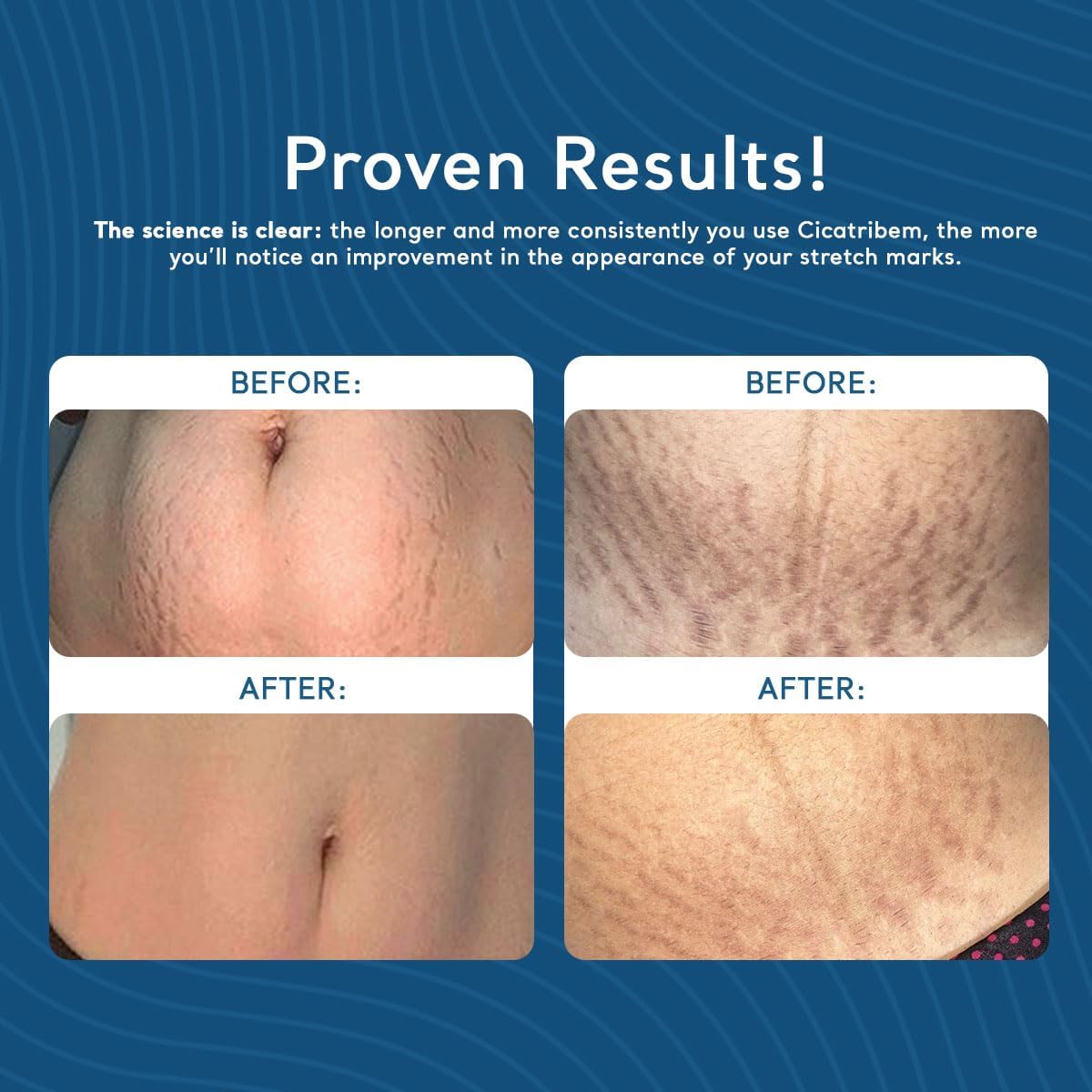 Creme para Estrias Cicatribem 150g - Image 2